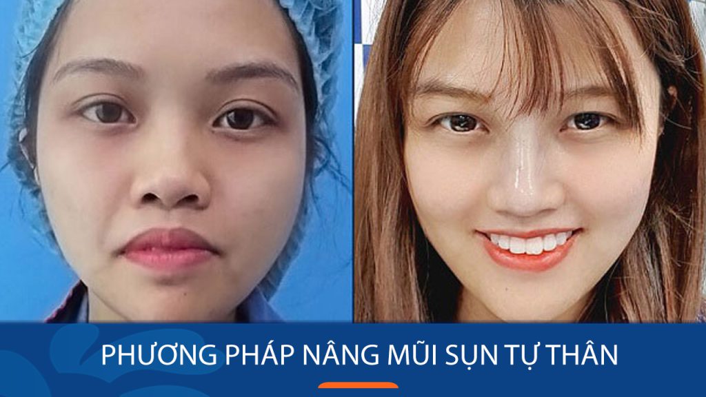 Nâng mũi sụn tự thân: Bí quyết sở hữu dáng mũi đẹp hoàn hảo