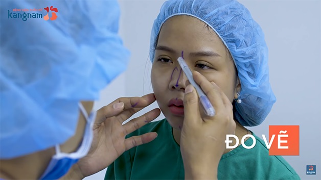 Bác sĩ tiến hành đo vẽ dáng mũi trước khi thực hiện phẫu thuật