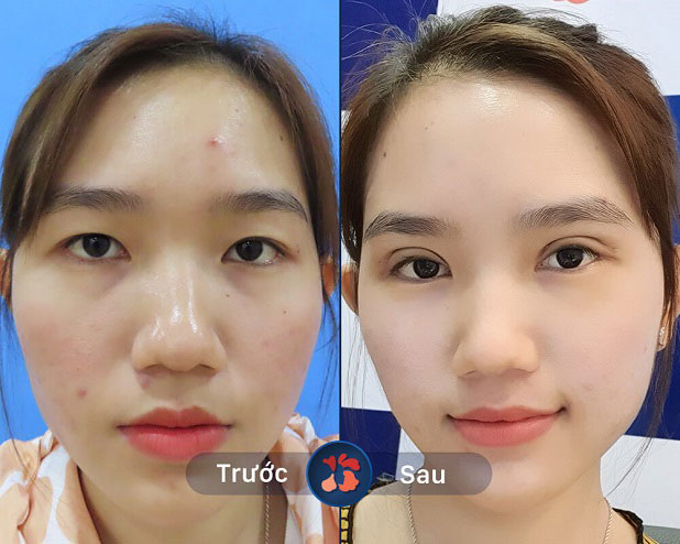 Kết quả trước và sau khi khách hàng tiêm botox