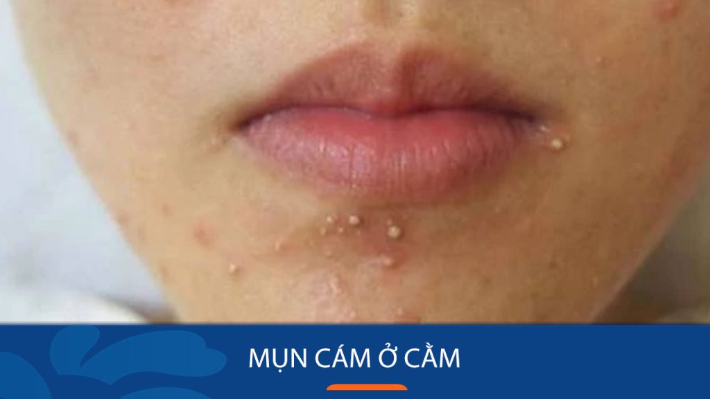 Mụn Cám Ở Cằm? “Tiêu diệt” Hiệu quả với 7 Cách Siêu Dễ Tại Nhà