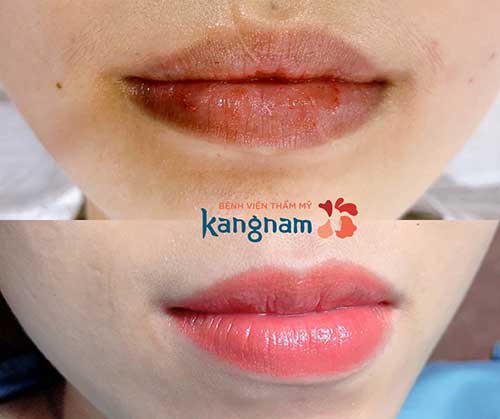 Nét đẹp trẻ trung tươi tắn sau khi tạo hình khóe môi cười tại TMV Kangnam
