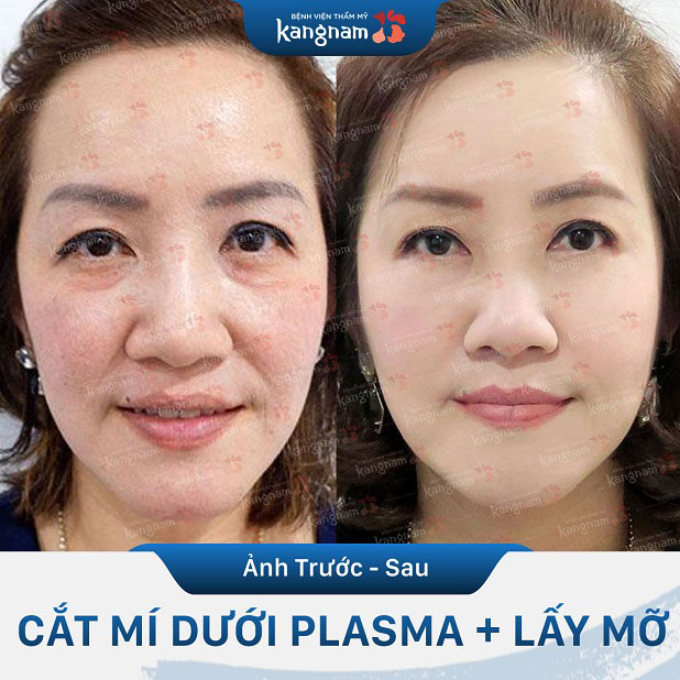 Khách cắt mí dưới Plasma + lấy mỡ tại Kangnam