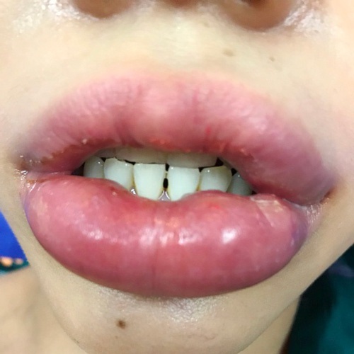 biến chứng tiêm filler môi