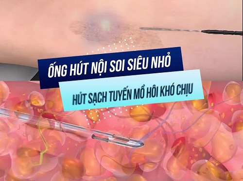 công nghệ endo dry trị hôi nách