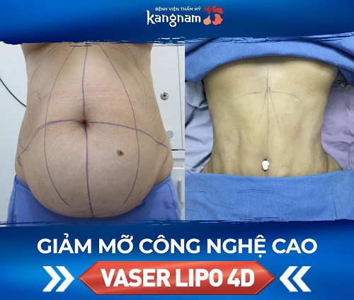 công nghệ hút mỡ Vaser Lipo