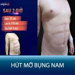 Hút Mỡ Bụng Cho Nam Giới: Loại bỏ bụng phệ , bụng bia trong “1 nốt nhạc”