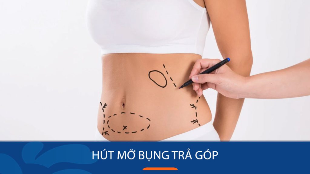 Hút mỡ bụng trả góp 0%: Sự thật hay chỉ là Chiêu trò truyền thông