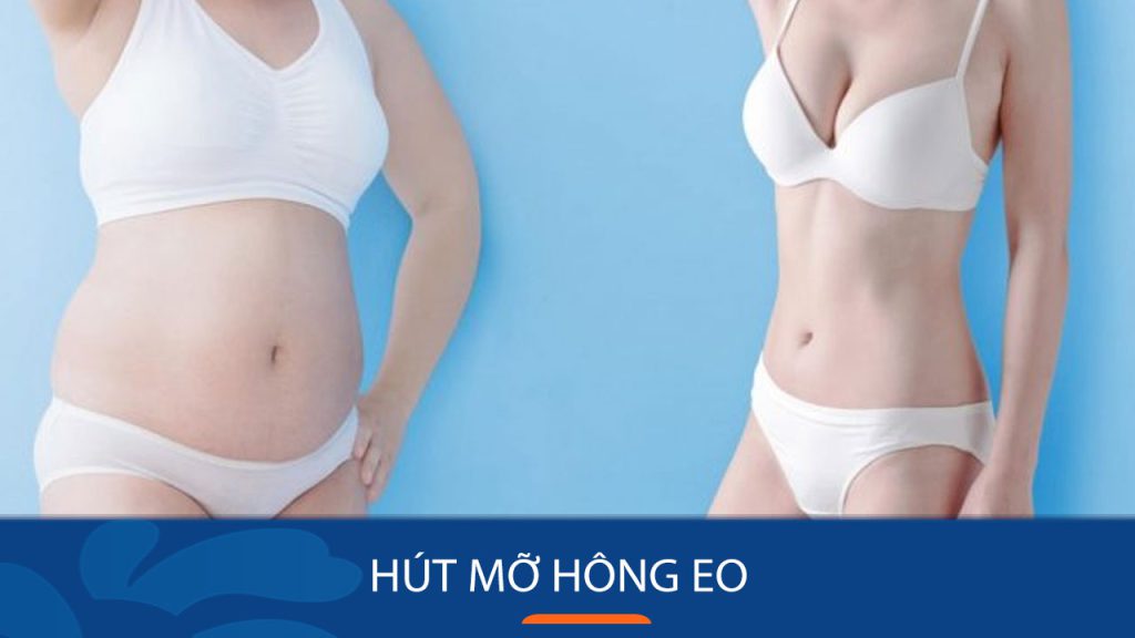Hút mỡ hông eo – “Biến hóa” vóc dáng body chuẩn đẹp như siêu mẫu