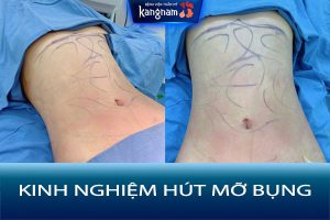 13 kinh nghiệm hút mỡ bụng an toàn, hiệu quả, không di chứng