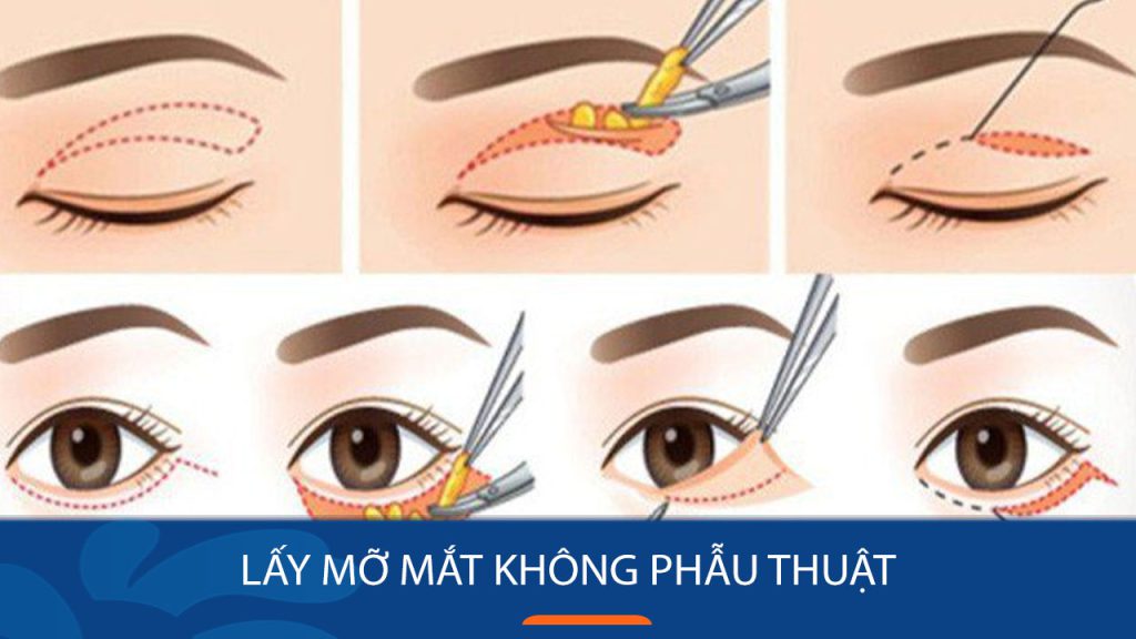 Lấy mỡ mắt không phẫu thuật: Ưu điểm, Quy Trình, Tác dụng phụ