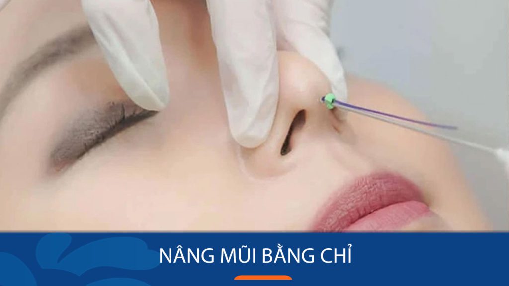 Nâng mũi bằng chỉ: Bí quyết sở hữu dáng mũi đẹp không phẫu thuật