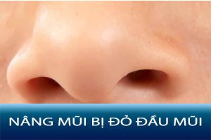 Nguyên nhân và cách giảm bị đỏ đầu mũi sau phẫu thuật nâng mũi