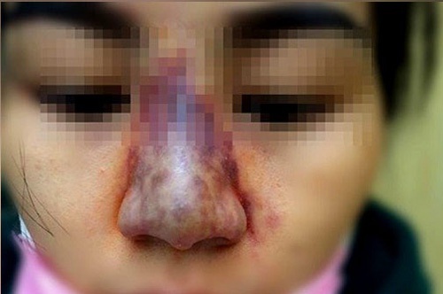 Nâng mũi bị nhiễm trùng nguyên nhân do đâu