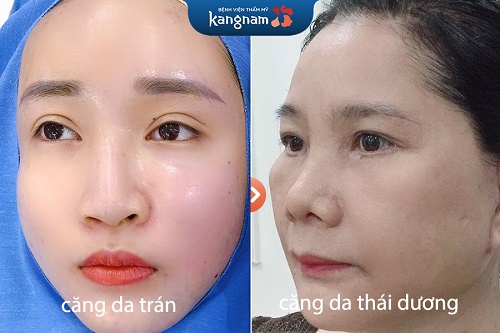 so sánh dịch vụ căng da