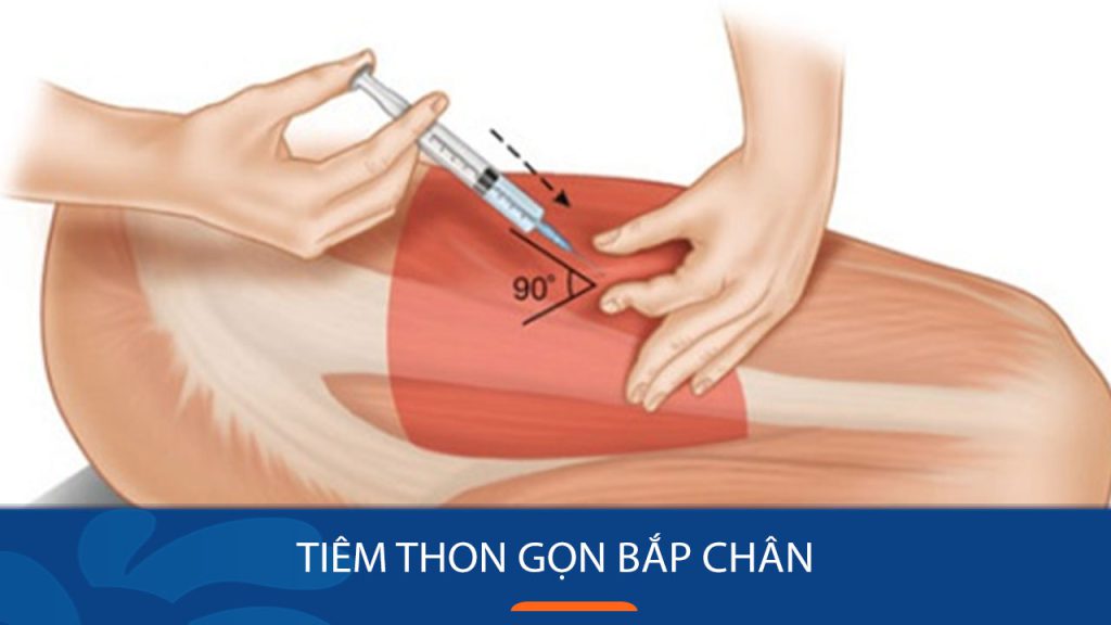 Tiêm thon gọn bắp chân: Bí kíp sở hữu dáng vẻ nuột nà quyến rũ