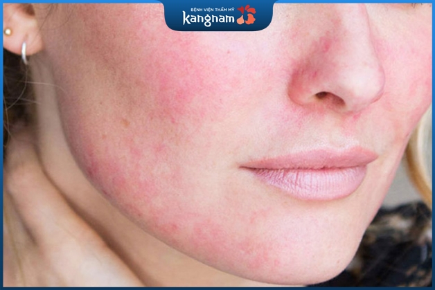 Viêm nhiễm có thể xảy ra sau khi căng chỉ trẻ hóa da mặt