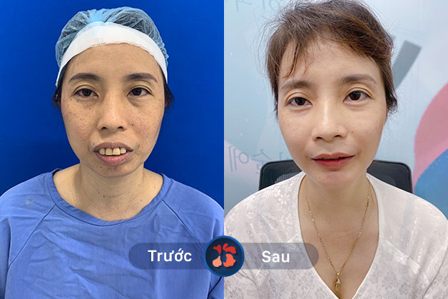 Khách hàng trước và sau khi phẫu thuật cười hở lợi tại Kangnam