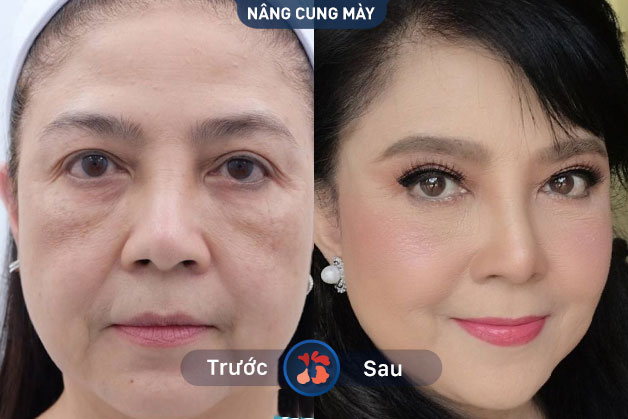 Treo cung chân mày có thể giữ được lâu dài nếu bạn biết cách chăm sóc