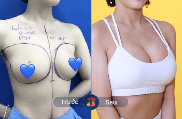 Hình ảnh trước và sau khi nâng ngực của khách hàng