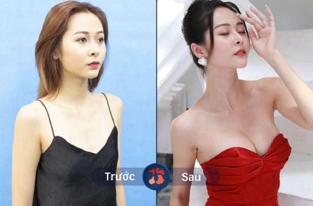 Trước và sau khi nâng ngực tại Kangnam