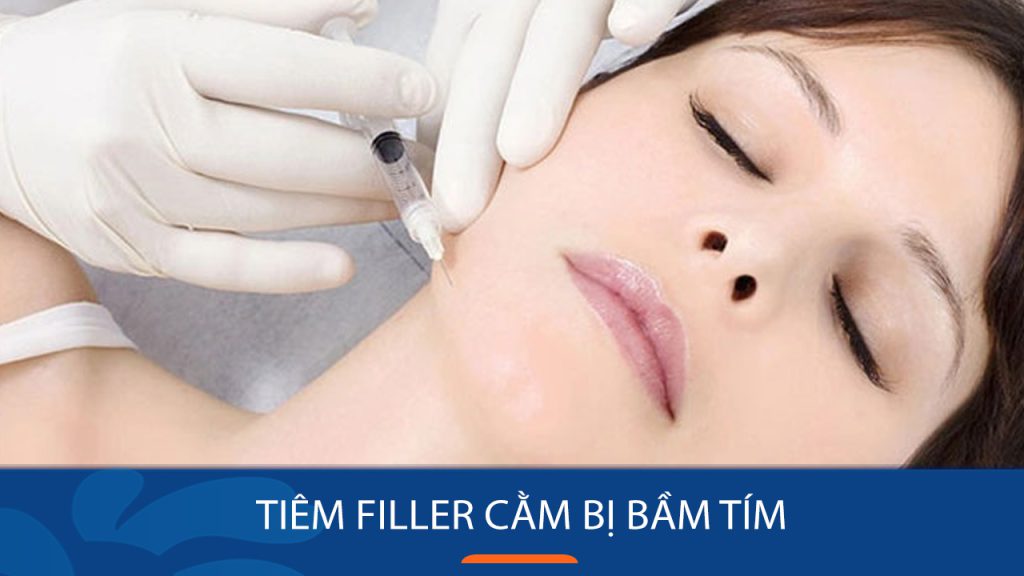 Tiêm filler cằm bị bầm tím: Mức độ bình thường và cách xử lý hiệu quả