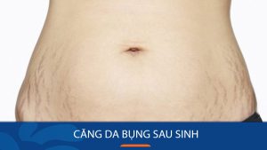 Căng da bụng sau sinh: Phẫu thuật trẻ hóa vòng 2 Căng mịn, Sexy