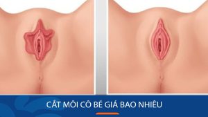 Cắt môi bé giá bao nhiêu? Bảng giá cập nhật mới nhất