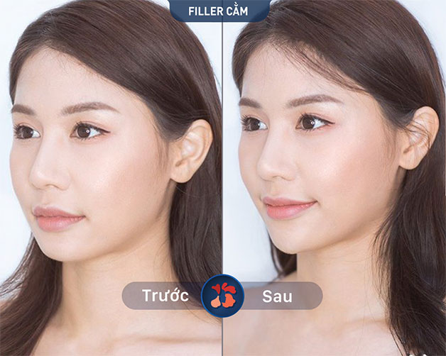 Khách hàng sở hữu cằm Vline ngay sau khi tiêm filler cằm