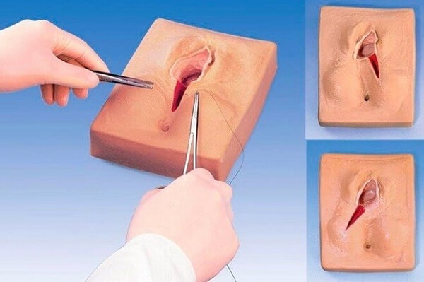 phẫu thuật cắt môi bé