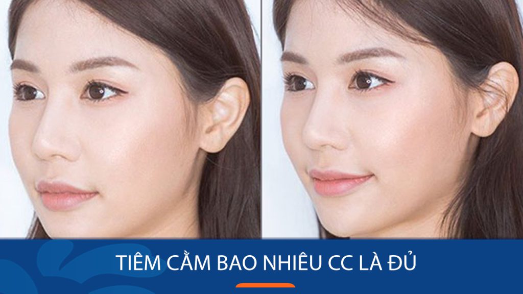 Tiêm cằm bao nhiêu cc là đẹp? Giải đáp thắc mắc từ chuyên gia