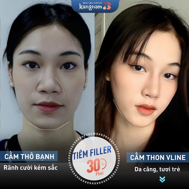 Sau 30 phút tiêm filler cằm hết thô bạnh