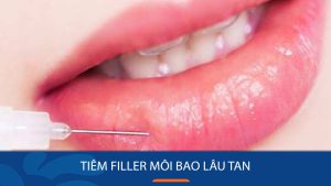 Tiêm Filler môi bao lâu tan? Giữ được trong thời gian bao lâu