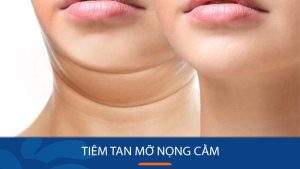 Tiêm tan mỡ nọng cằm là gì – Cơ chế và quá trình thực hiện