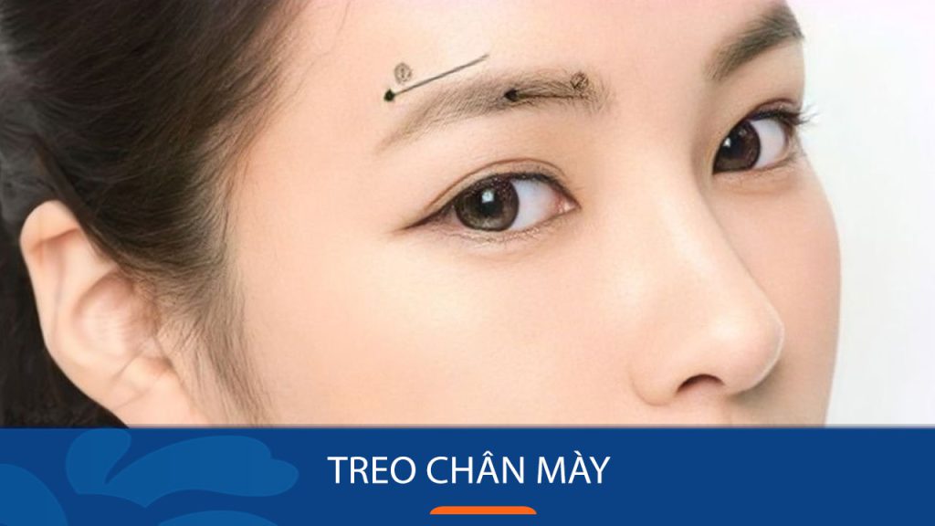 Treo chân mày là gì? có để lại sẹo không “Cứu cánh” cho đôi lông mày sụp mí, da chùng