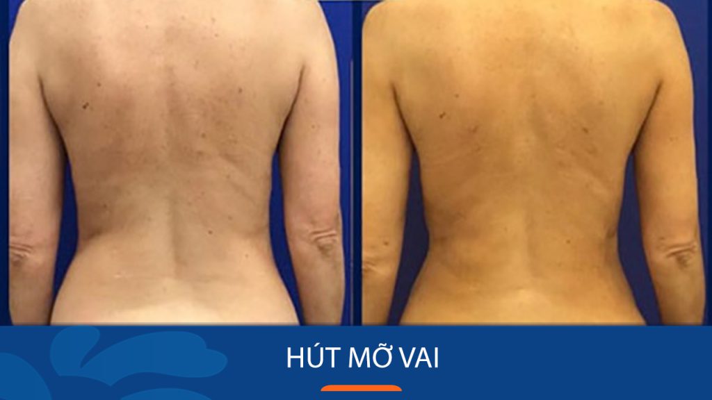 Hút mỡ vai: Quy trình, chi phí và cách đảm bảo an toàn