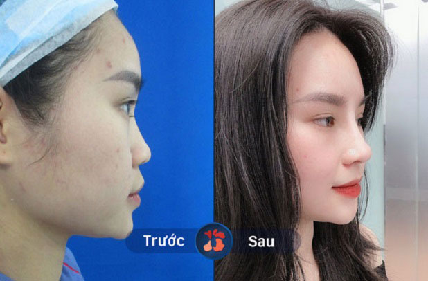 Trước và sau khi khách hàng nâng mũi tại Kangnam