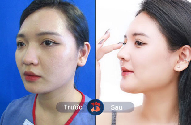 Form mũi thay đổi sau khi khách hàng nâng mũi tại Kangnam