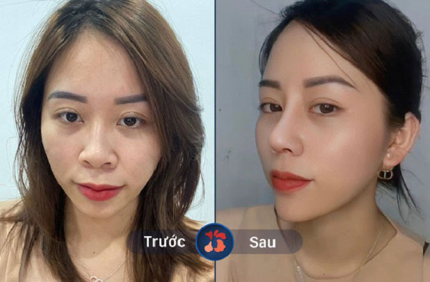 Trước và sau khi khách hàng nâng mũi tại Kangnam