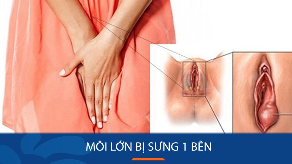 Môi lớn sưng một bên: Nguyên nhân và cách xử lý nhanh chóng, hiệu quả
