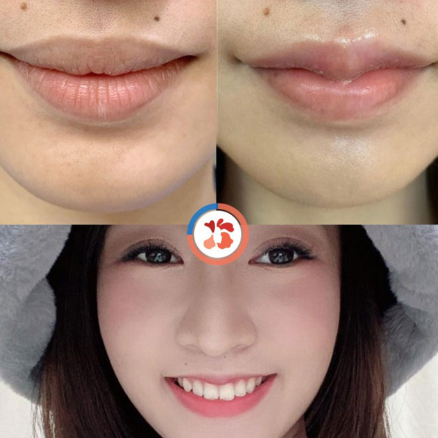 Chị Hà Thu Trang chia sẻ cảm nhận sau khi tiêm môi 