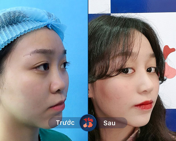 Khách hàng trước và sau khi cải thiện dáng mũi tại Kangnam