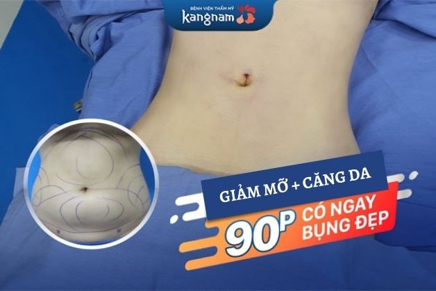 BVTM Kangnam - Địa chỉ căng da bụng tpHCM, Hà Nội chuẩn đẹp
