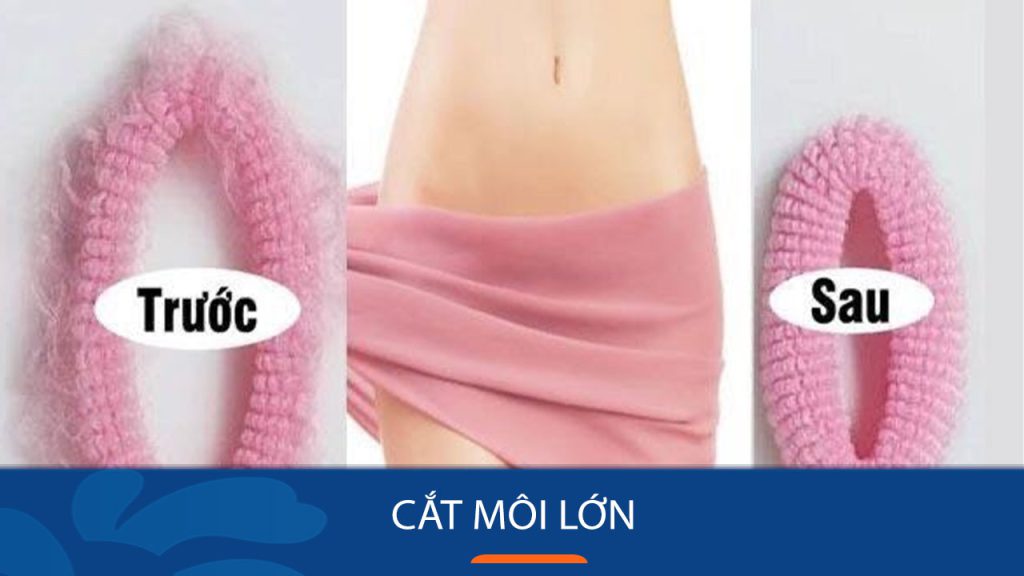 Cắt môi lớn: “Tuyệt chiêu” gìn giữ cô bé tươi trẻ, săn chắc