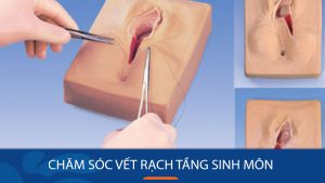 Chia Sẻ Kinh Nghiệm Chăm Sóc Vết Rạch Tầng Sinh Môn Sau Sinh