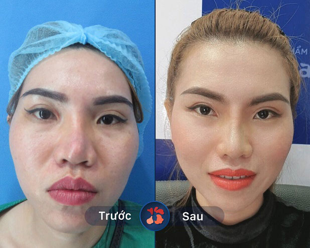 Trước và sau khi sửa mũi tại Kangnam