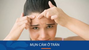 6 Bí quyết Đánh bay Mụn cám ở trán Nhanh – Hiệu quả – An toàn tại nhà