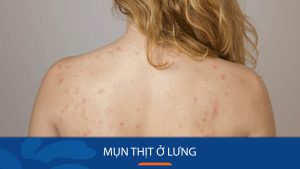 Mụn thịt ở lưng: Loại bỏ mụn thịt ở lưng vĩnh viễn tại nhà