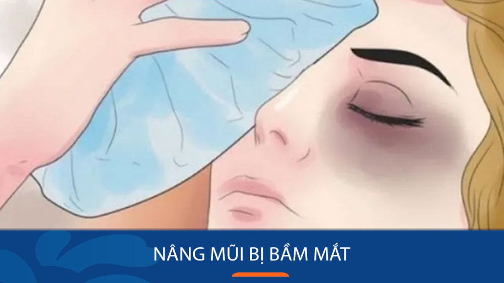Nâng Mũi Bị Bầm Mắt: Nhận biết hiện tượng bình thường hay bất thường