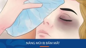 Nâng Mũi Bị Bầm Mắt: Nguyên nhân và cách giảm bầm mắt