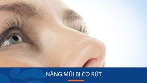 Nâng Mũi Bị Co Rút: Nguyên Nhân & hạn chế mũi bị co rút